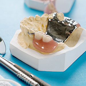 ARPDCouldBeYourAnswertoReplacingMissingTeeth