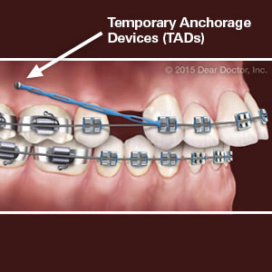 AnchorageDevicesProvideMoreAccuracyLessTreatmentTimeforBraces