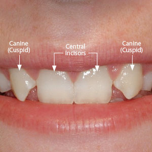 front tooth enamel loss