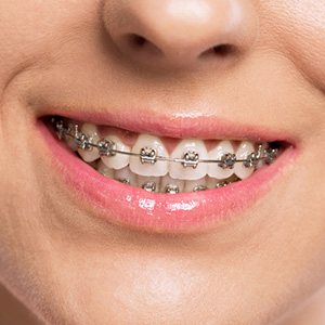 Understanding the Aging Process Leads to More Effective Orthodontics Understanding the Aging Process Leads to More Effective Orthodontics