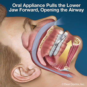 ThisOralApplianceCouldHelpSolveYourSleepApneaProblem