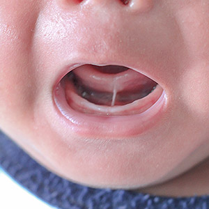 ThisMinorDentalProcedureCouldMakeBreastfeedingEasierforanInfant