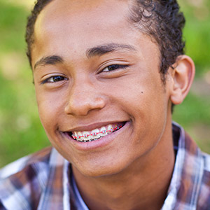 CorrectingaPoorBiteWithBraces-aTrueWonder