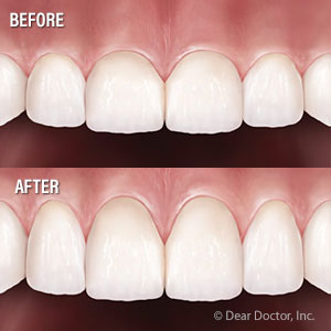 CrownLengtheningMightbeNecessaryforSeniorswithToothDecay