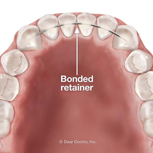 Bonded Retainers Provide a Less Noticeable Option for Keeping Teeth Straight
