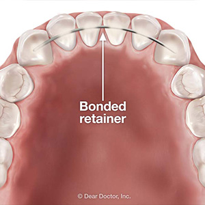 2KindsofOrthodonticRetainersThatCanProtectYourNewSmile