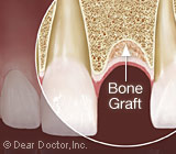 BoneGraftingcanputImplantsBackonYourOptionsList