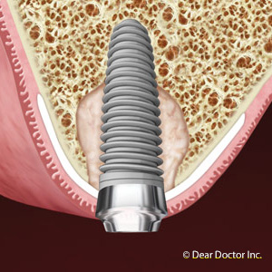 IncreaseBoneMassforDentalImplantsthroughGrafting