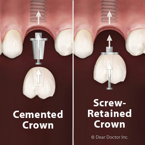 ChoosingaScreworCementtoAttachanImplantCrown
