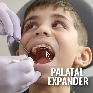 expanders for teeth age