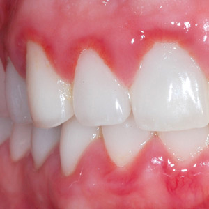 YourCaseofGingivitisCouldDevelopintoSomethingMoreHarmful