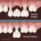 Could a Dental Bridge Be a Better Choice Than Implants? Could a Dental Bridge Be a Better Choice Than Implants?