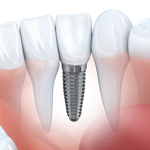 4ReasonstoConsiderDentalImplants