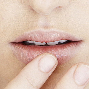 GetRelieffromCrackedCornersoftheMouth