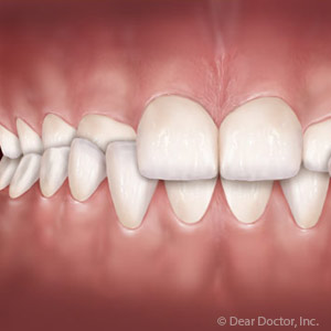 EarlyInterventioncanCorrectAbnormalUpperJawandPalateGrowth