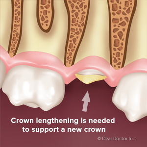 CrownLengtheningOpensupNewTeethRestorationPossibilities