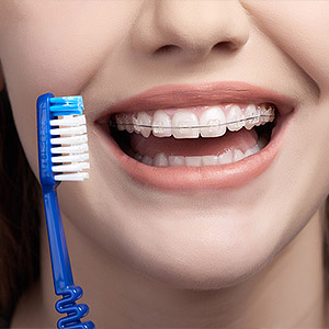 PuttheExtraEffortinYourOralHygieneWhileWearingBraces