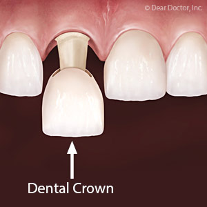 Crowns Could be the Smile Solution for Some Unattractive Teeth