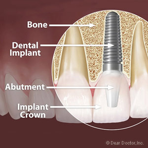 dental implant.