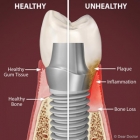 Two Major Causes for Implant Failure and How You Can Prevent Them Two Major Causes for Implant Failure and How You Can Prevent Them
