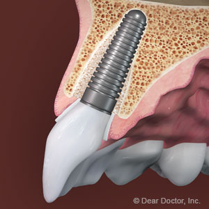 SuccesswithDentalImplantsDependsonAttentiontoDetail