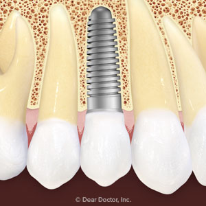 HeresWhatYouCanExpectWithDentalImplantSurgery