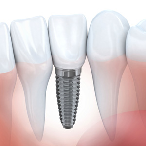 MoreThananewSmile-DentalImplantsHelpStopBoneLossasWell