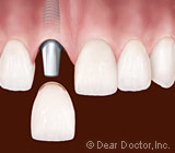 dental implant.