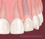 ImmediateImplantscanReduceTreatmentStepsandTime