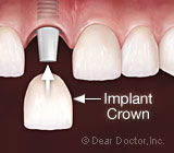 TestingyourKnowledgeDentalImplants