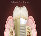 FactorsthatCanInfluenceaDentalImplant