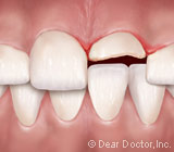 dental injuries.