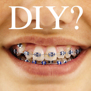 The Dangers of DIY Braces The Dangers of DIY Braces