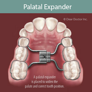 InterceptiveOrthodonticsStoppingPoorBitesBeforeTheyDevelop