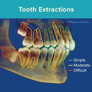 SimpleToothExtractionsareaCommonDentalProcedure