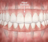 FrequentlyAskedQuestionsaboutFixedDentures