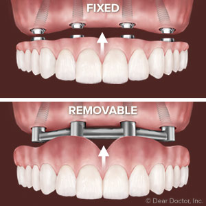Permanent Dentures Implants Pictures  . Dental Implants Are Replacement Tooth Roots Made Of Titanium.