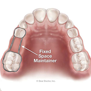 TakeStepstoSaveanIncomingToothsPlacetoAvoidaPoorBite