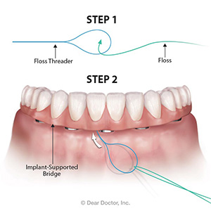 WhyYouShouldStillFlosswithanImplant-SupportedBridge