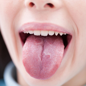 ThoseRedPatchesonYourTongueareNothingtobeAlarmedAbout