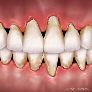 OtherFactorsBesidesHygieneCouldContributetoGumDisease