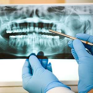 TreatingGumDiseaseImportanttoSavingtheUnderlyingBone