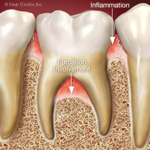 GumDiseaseAroundtheToothRootsCanBeDifficulttoAccessandTreat