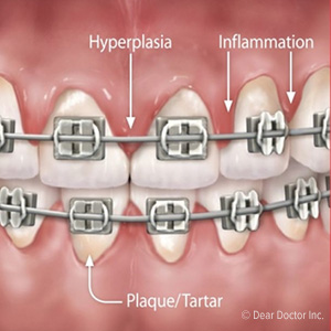 WhatYouCanDoToReduceGumProblemsWhileWearingBraces