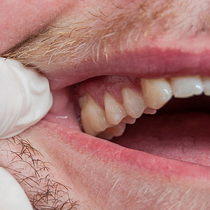 Watchforthese4SignsofGumDisease