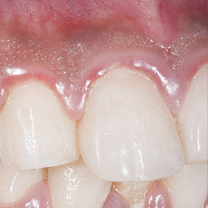 DontDelayTreatmentofGumDisease