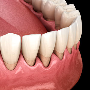 DontDelaySeeingtheDentistIfYouSuspectGumRecession