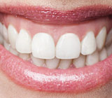gummy smile.