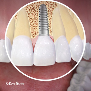 3CuttingEdgeWaysYouCouldBenefitfromDentalImplants