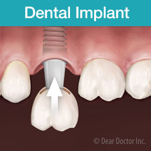 3ReasonsforWhyItsaSmartMovetoInvestinDentalImplants